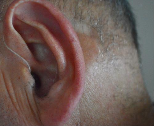 Acetic acid can help with ear infections.